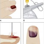subungual hematoma